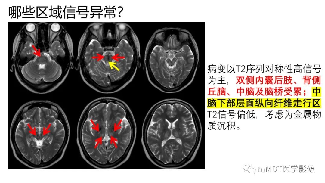 影像PPT - 【PPT】肝豆—熊猫征分析及综述-9 影像PPT - 【PPT】肝豆—熊猫征分析及综述-9
