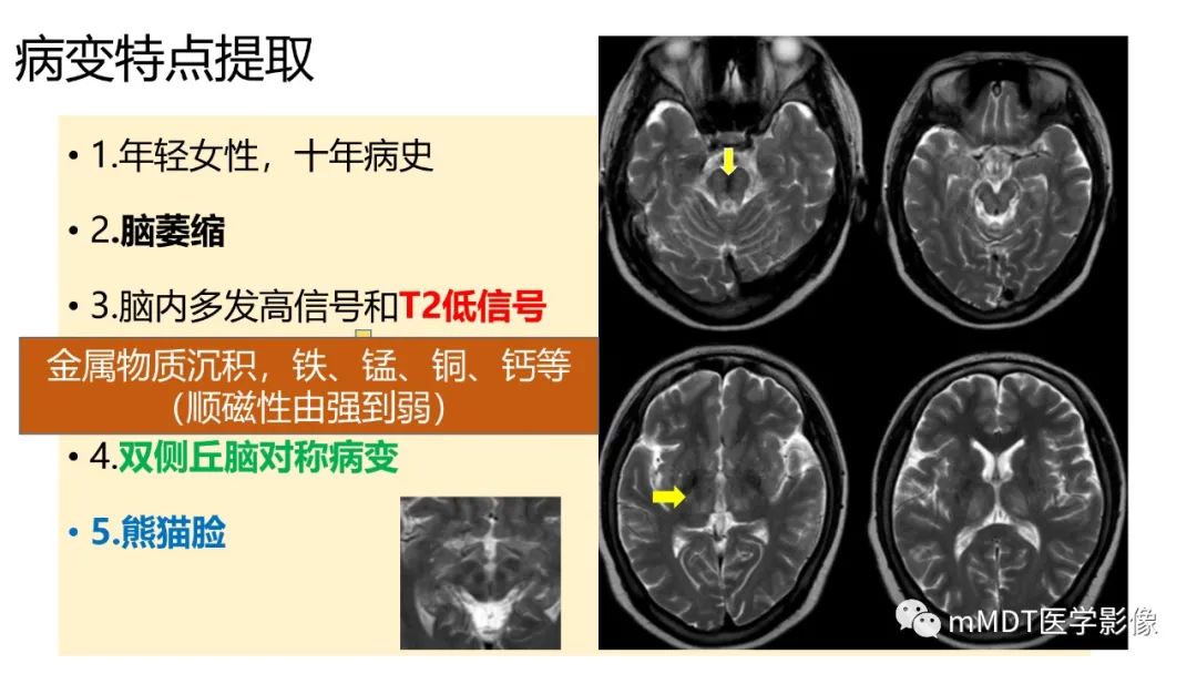 影像PPT - 【PPT】肝豆—熊猫征分析及综述-10 影像PPT - 【PPT】肝豆—熊猫征分析及综述-10