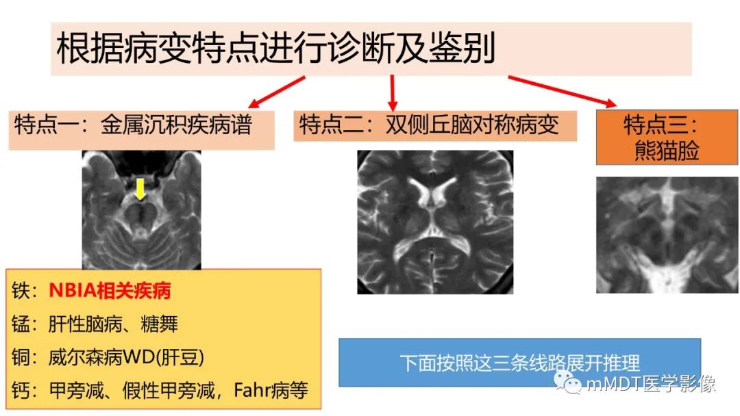 影像PPT - 【PPT】肝豆—熊猫征分析及综述-11 影像PPT - 【PPT】肝豆—熊猫征分析及综述-11