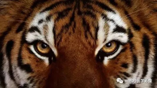 影像PPT - 【PPT】肝豆—熊猫征分析及综述-15 影像PPT - 【PPT】肝豆—熊猫征分析及综述-15