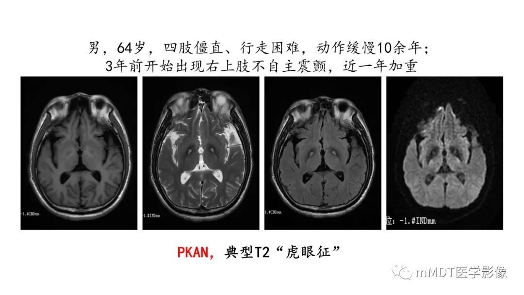影像PPT - 【PPT】肝豆—熊猫征分析及综述-14 影像PPT - 【PPT】肝豆—熊猫征分析及综述-14