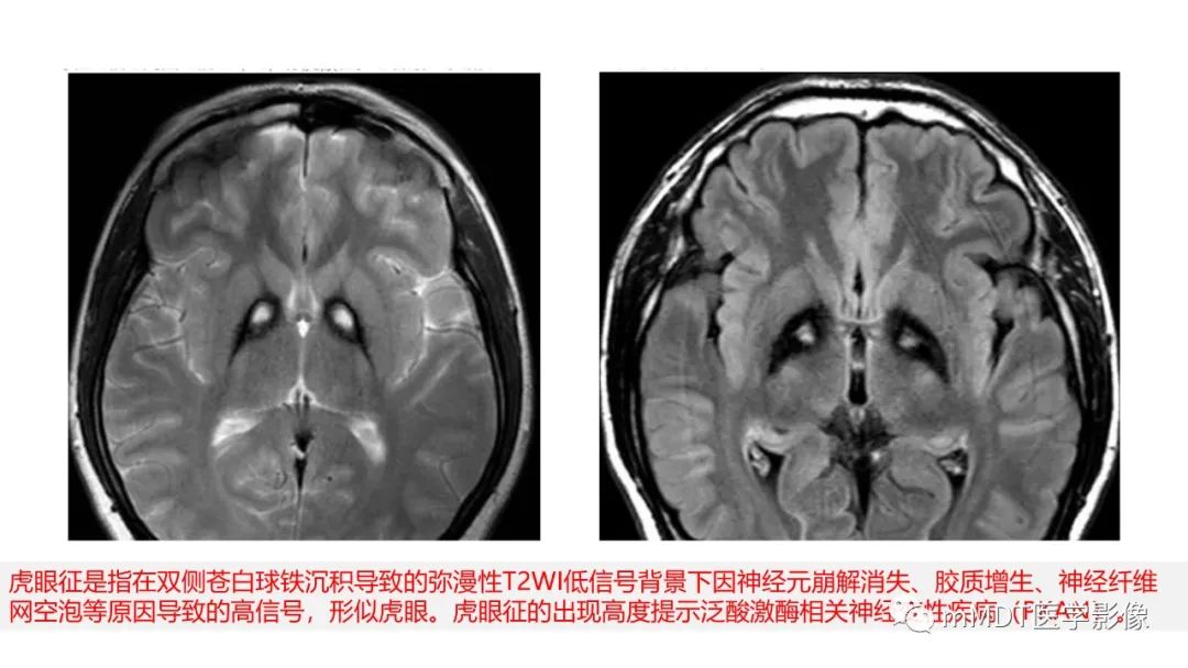 影像PPT - 【PPT】肝豆—熊猫征分析及综述-16 影像PPT - 【PPT】肝豆—熊猫征分析及综述-16