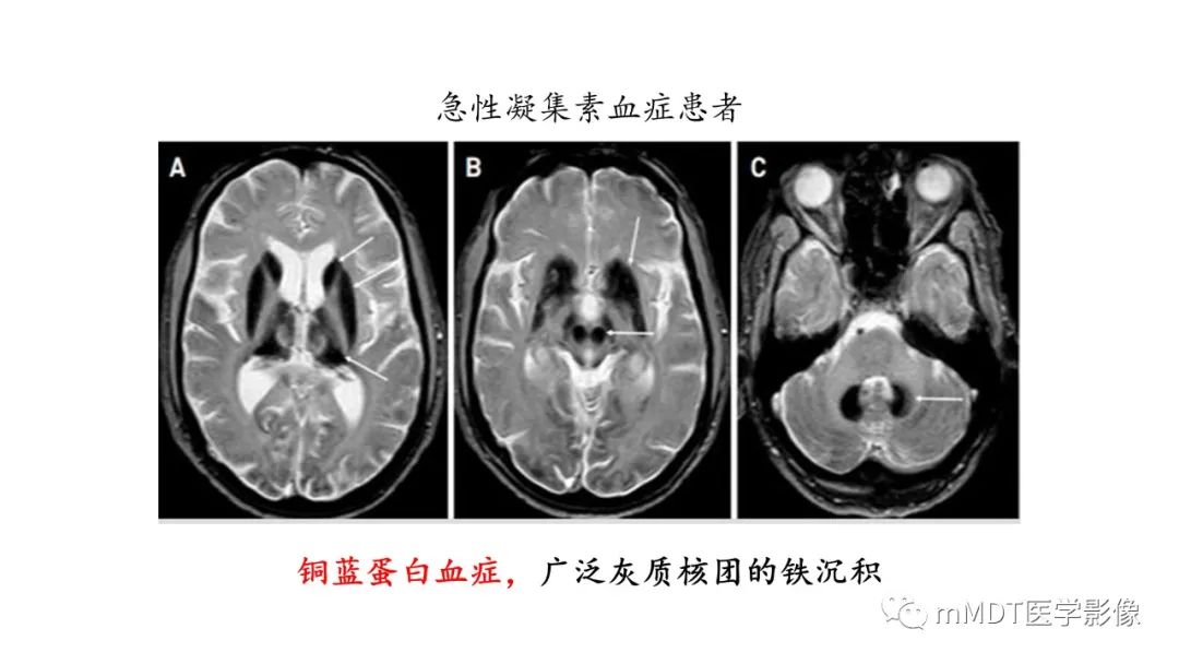 影像PPT - 【PPT】肝豆—熊猫征分析及综述-20 影像PPT - 【PPT】肝豆—熊猫征分析及综述-20
