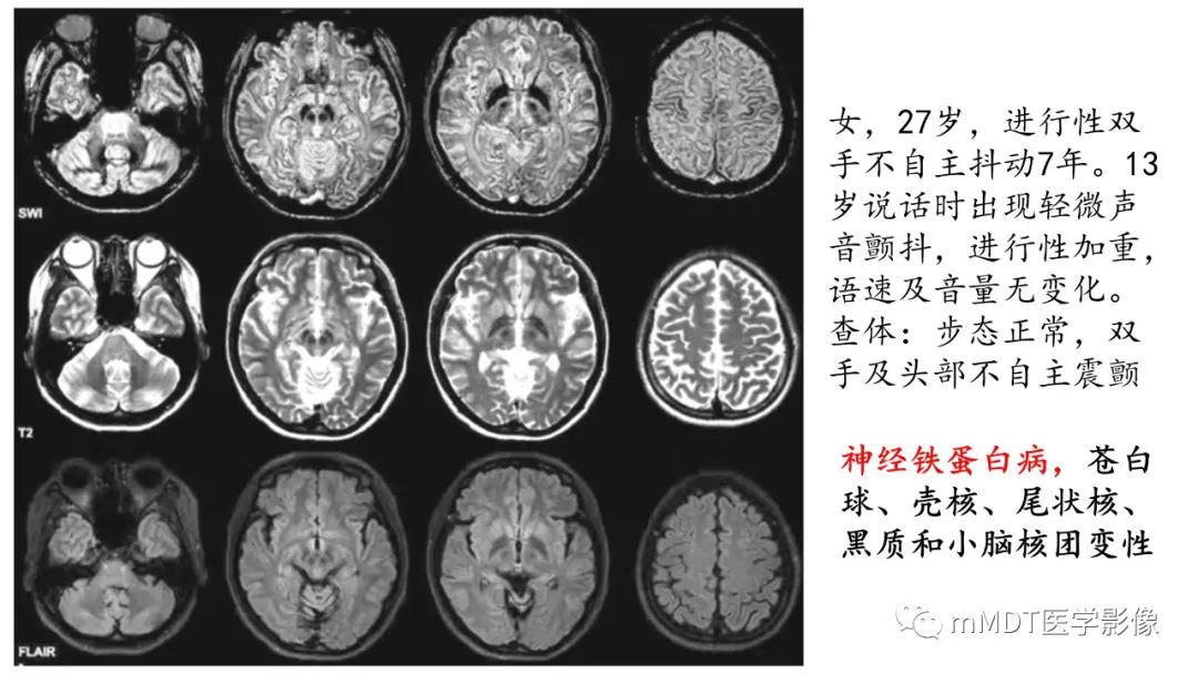 影像PPT - 【PPT】肝豆—熊猫征分析及综述-19 影像PPT - 【PPT】肝豆—熊猫征分析及综述-19