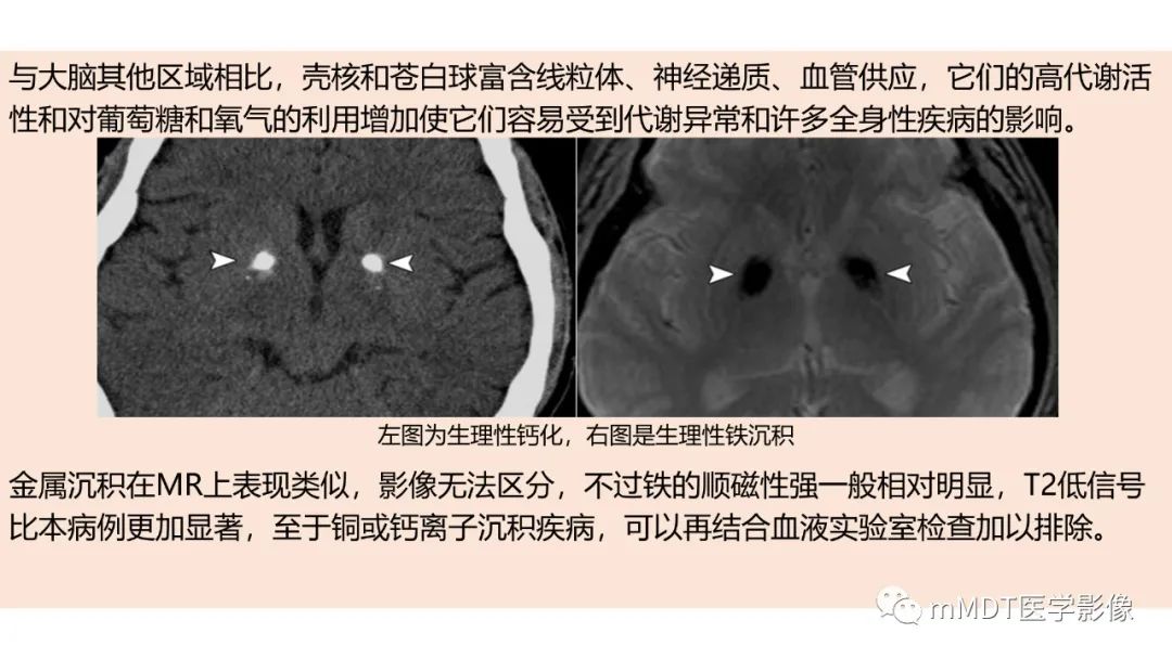 影像PPT - 【PPT】肝豆—熊猫征分析及综述-21 影像PPT - 【PPT】肝豆—熊猫征分析及综述-21