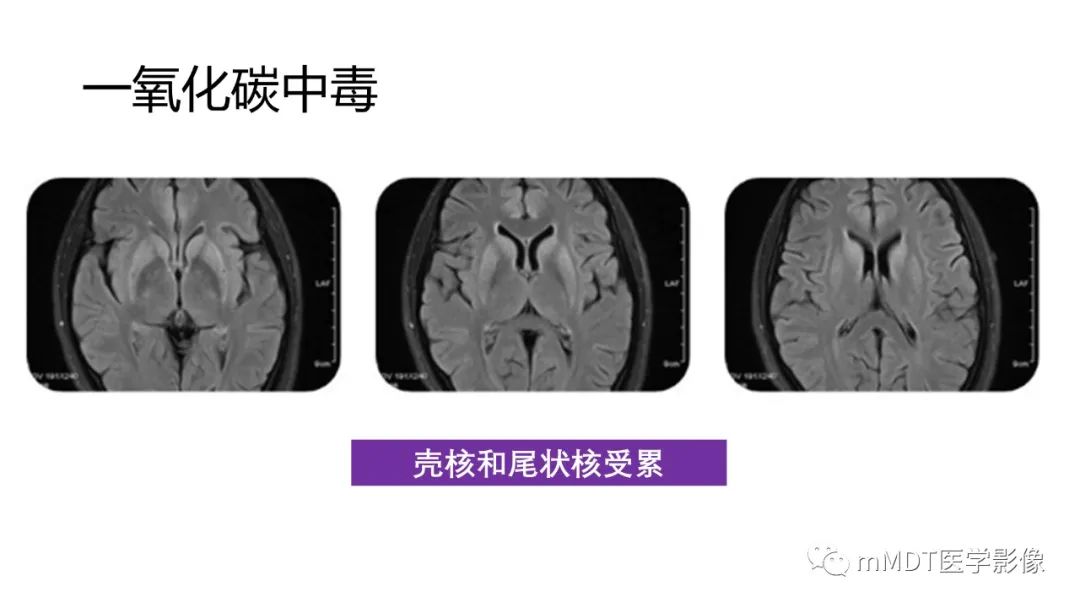 影像PPT - 【PPT】肝豆—熊猫征分析及综述-23 影像PPT - 【PPT】肝豆—熊猫征分析及综述-23