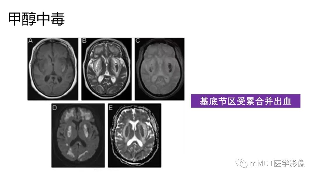 影像PPT - 【PPT】肝豆—熊猫征分析及综述-25 影像PPT - 【PPT】肝豆—熊猫征分析及综述-25