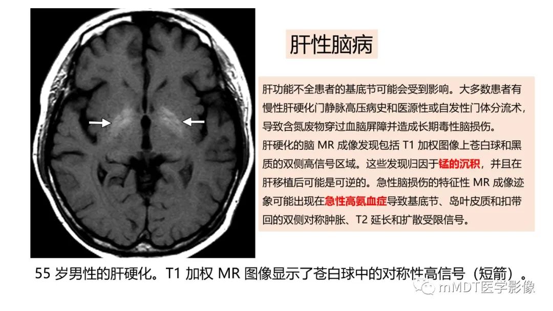 影像PPT - 【PPT】肝豆—熊猫征分析及综述-27 影像PPT - 【PPT】肝豆—熊猫征分析及综述-27