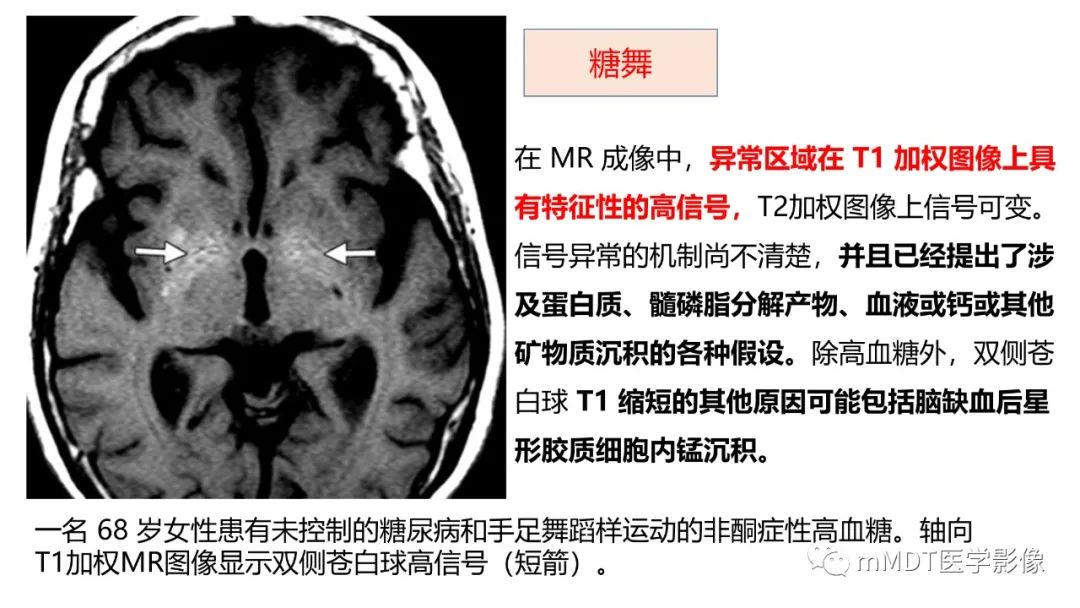 影像PPT - 【PPT】肝豆—熊猫征分析及综述-29 影像PPT - 【PPT】肝豆—熊猫征分析及综述-29
