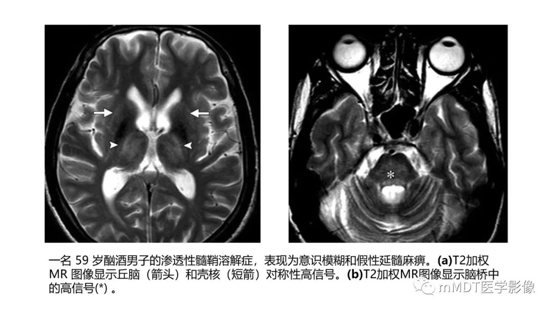 影像PPT - 【PPT】肝豆—熊猫征分析及综述-32 影像PPT - 【PPT】肝豆—熊猫征分析及综述-32