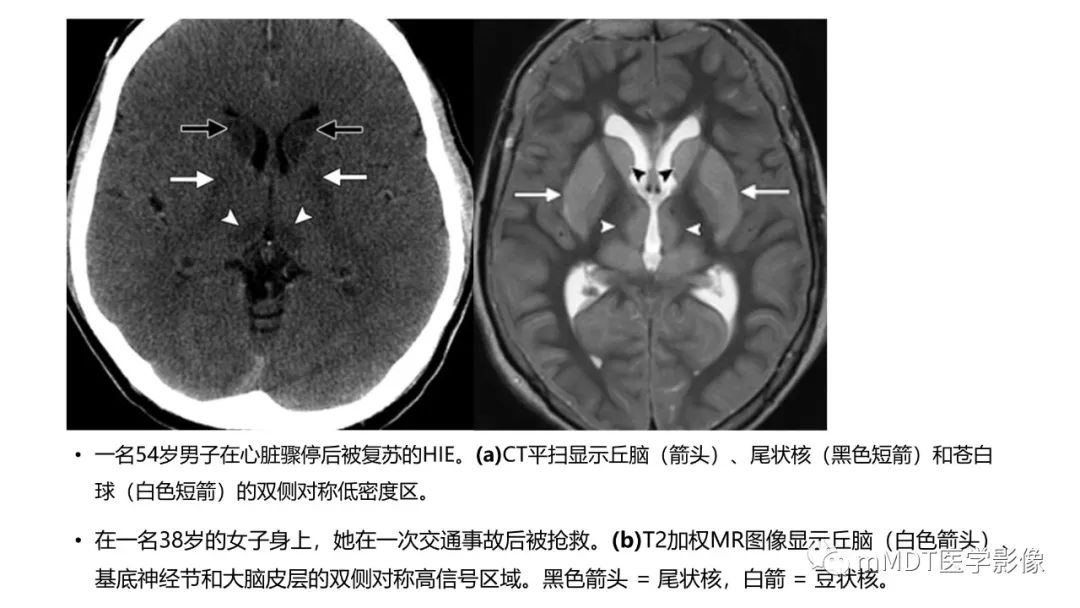 影像PPT - 【PPT】肝豆—熊猫征分析及综述-31 影像PPT - 【PPT】肝豆—熊猫征分析及综述-31