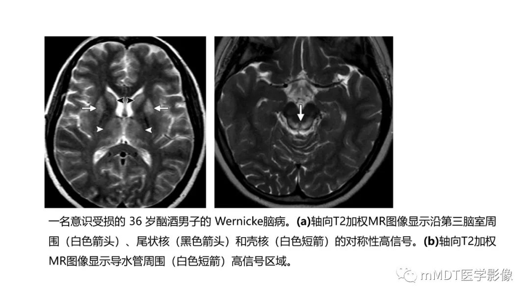 影像PPT - 【PPT】肝豆—熊猫征分析及综述-34 影像PPT - 【PPT】肝豆—熊猫征分析及综述-34