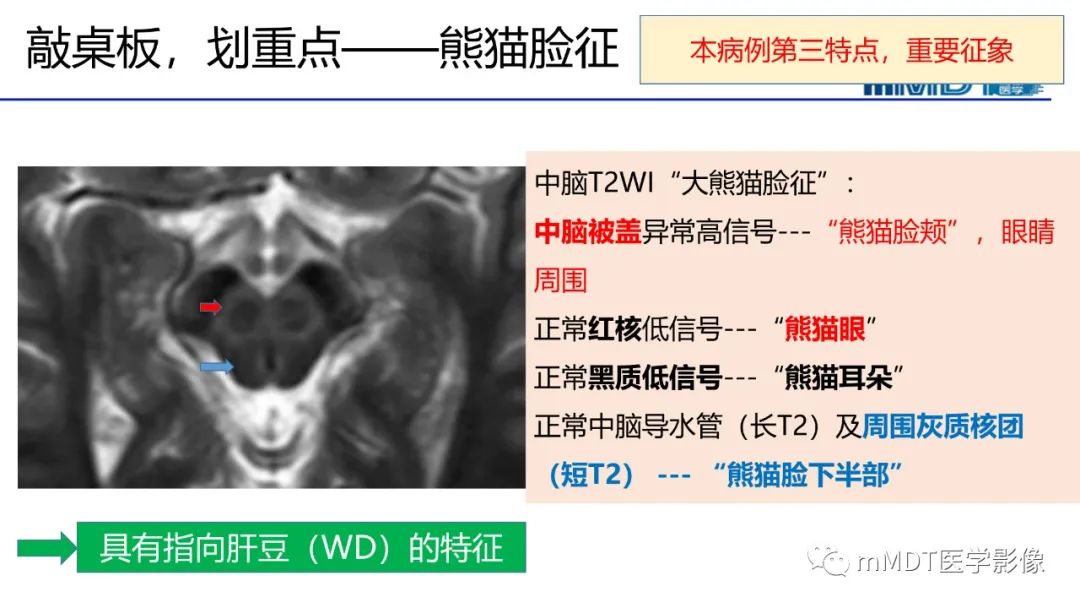 影像PPT - 【PPT】肝豆—熊猫征分析及综述-39 影像PPT - 【PPT】肝豆—熊猫征分析及综述-39