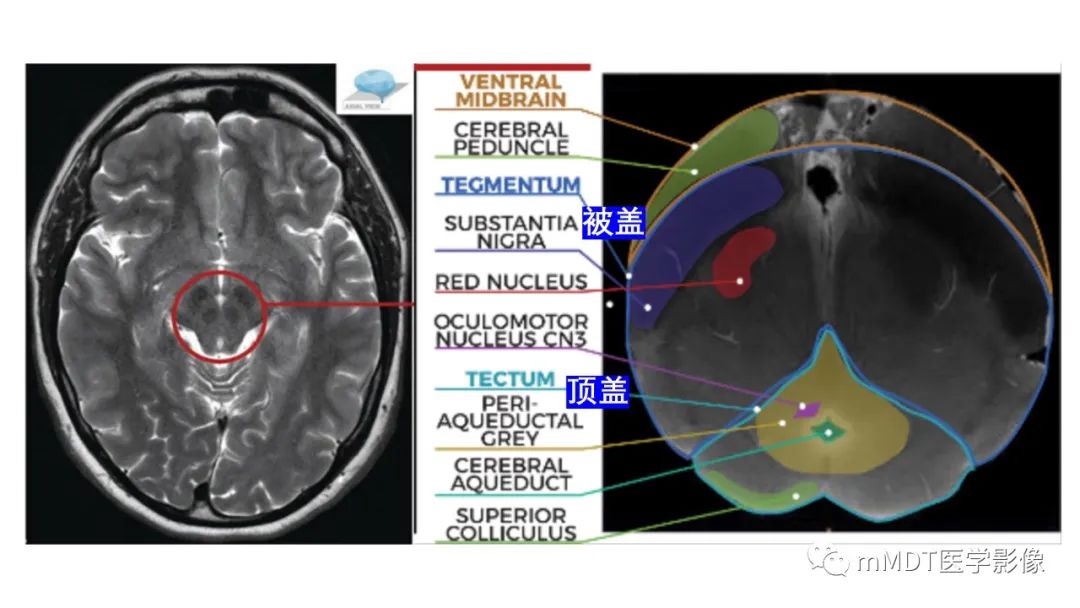 影像PPT - 【PPT】肝豆—熊猫征分析及综述-38 影像PPT - 【PPT】肝豆—熊猫征分析及综述-38