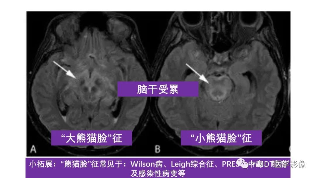 影像PPT - 【PPT】肝豆—熊猫征分析及综述-43 影像PPT - 【PPT】肝豆—熊猫征分析及综述-43