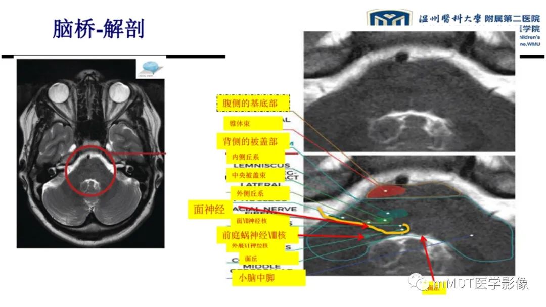 影像PPT - 【PPT】肝豆—熊猫征分析及综述-41 影像PPT - 【PPT】肝豆—熊猫征分析及综述-41