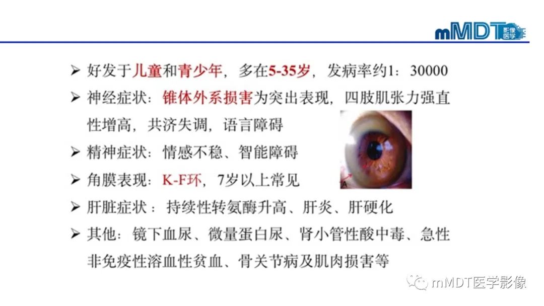 影像PPT - 【PPT】肝豆—熊猫征分析及综述-47 影像PPT - 【PPT】肝豆—熊猫征分析及综述-47