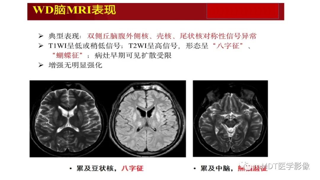 影像PPT - 【PPT】肝豆—熊猫征分析及综述-51 影像PPT - 【PPT】肝豆—熊猫征分析及综述-51