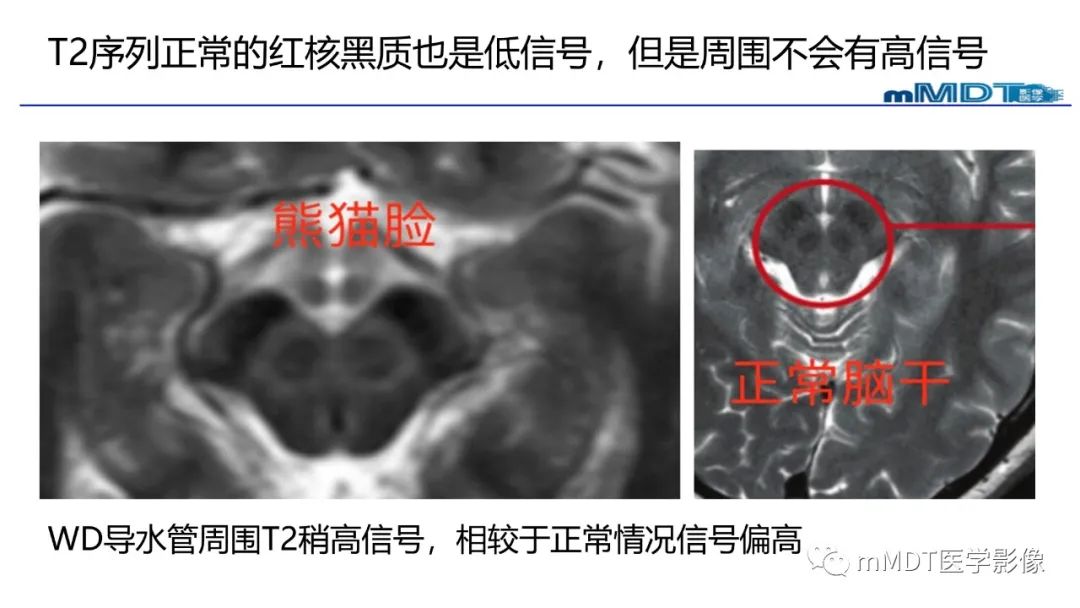 影像PPT - 【PPT】肝豆—熊猫征分析及综述-52 影像PPT - 【PPT】肝豆—熊猫征分析及综述-52