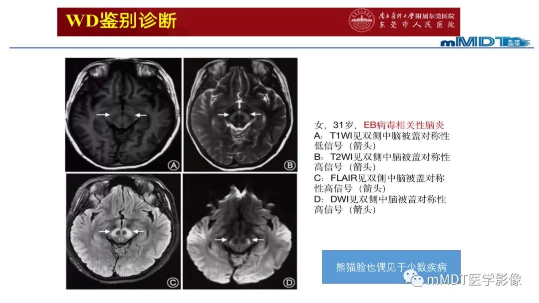 影像PPT - 【PPT】肝豆—熊猫征分析及综述-54 影像PPT - 【PPT】肝豆—熊猫征分析及综述-54