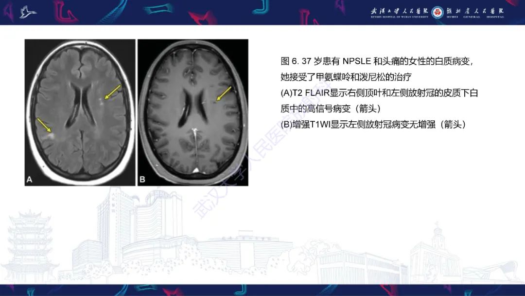 影像PPT - 【PPT】中枢神经系统性红斑狼疮影像诊断-12
