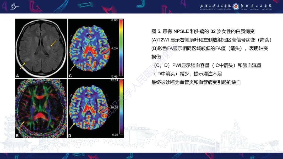 影像PPT - 【PPT】中枢神经系统性红斑狼疮影像诊断-11