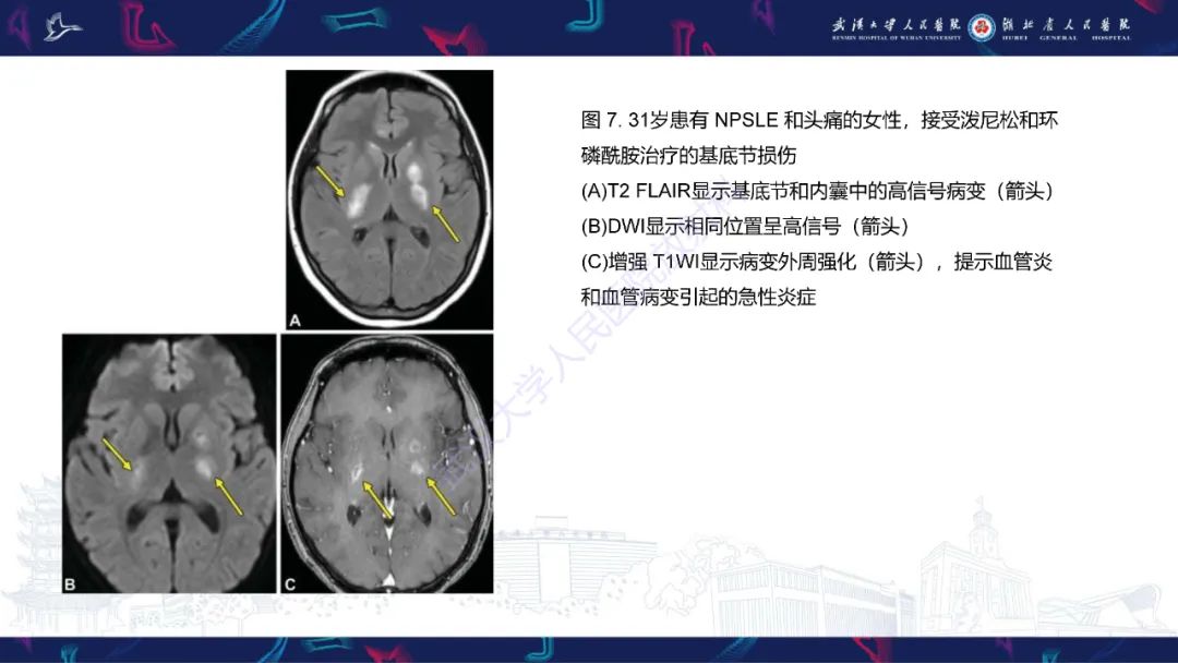 影像PPT - 【PPT】中枢神经系统性红斑狼疮影像诊断-14
