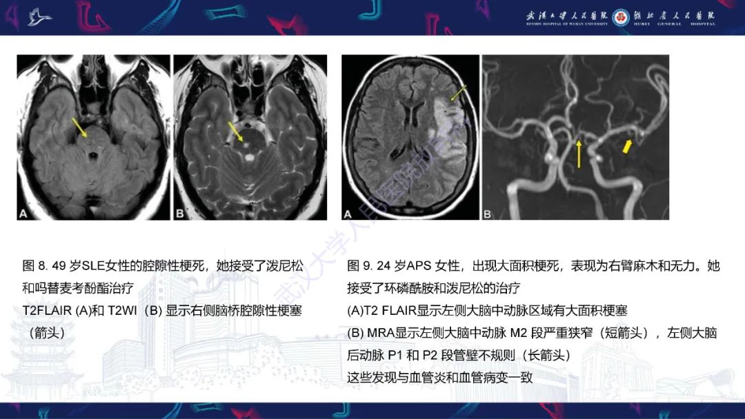 影像PPT - 【PPT】中枢神经系统性红斑狼疮影像诊断-16