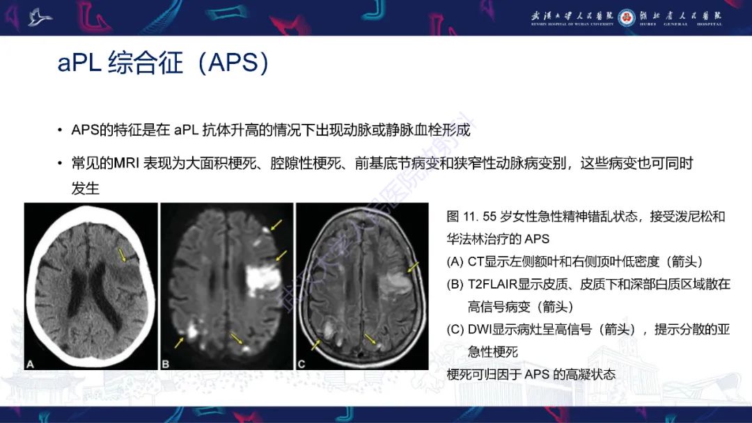 影像PPT - 【PPT】中枢神经系统性红斑狼疮影像诊断-19