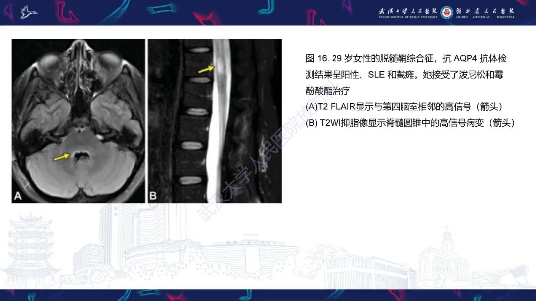 影像PPT - 【PPT】中枢神经系统性红斑狼疮影像诊断-23