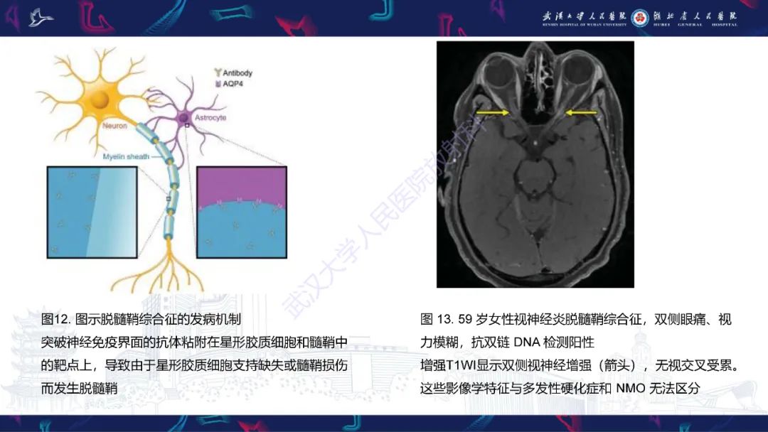 影像PPT - 【PPT】中枢神经系统性红斑狼疮影像诊断-21
