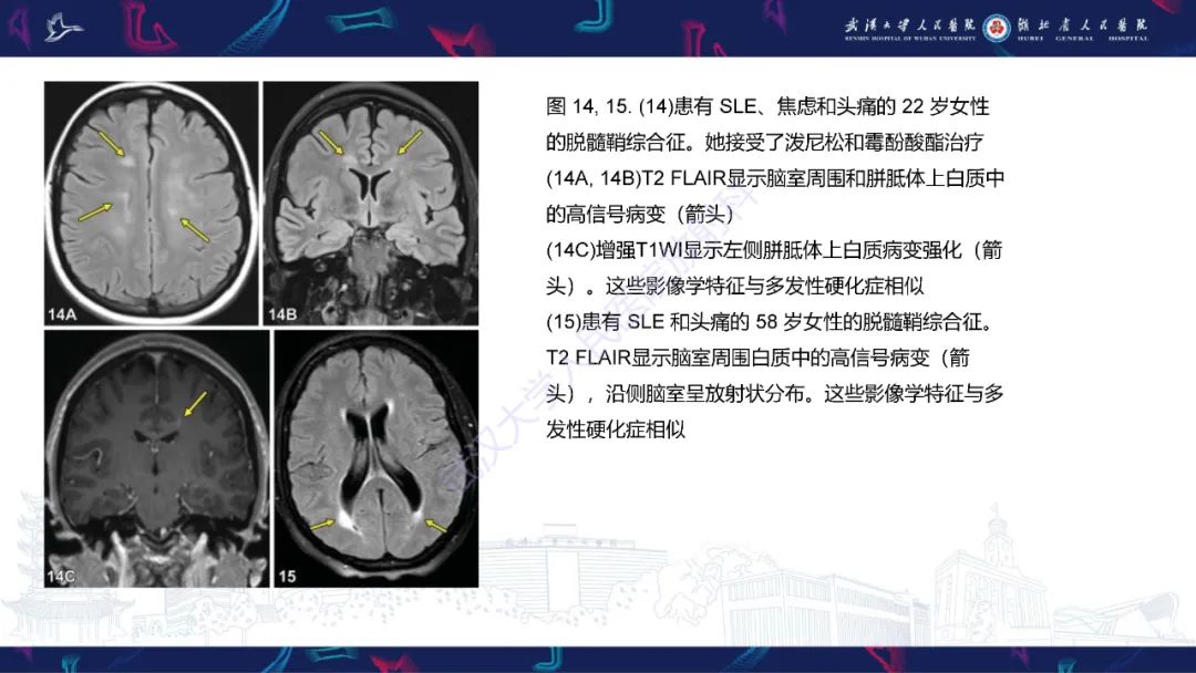 影像PPT - 【PPT】中枢神经系统性红斑狼疮影像诊断-22