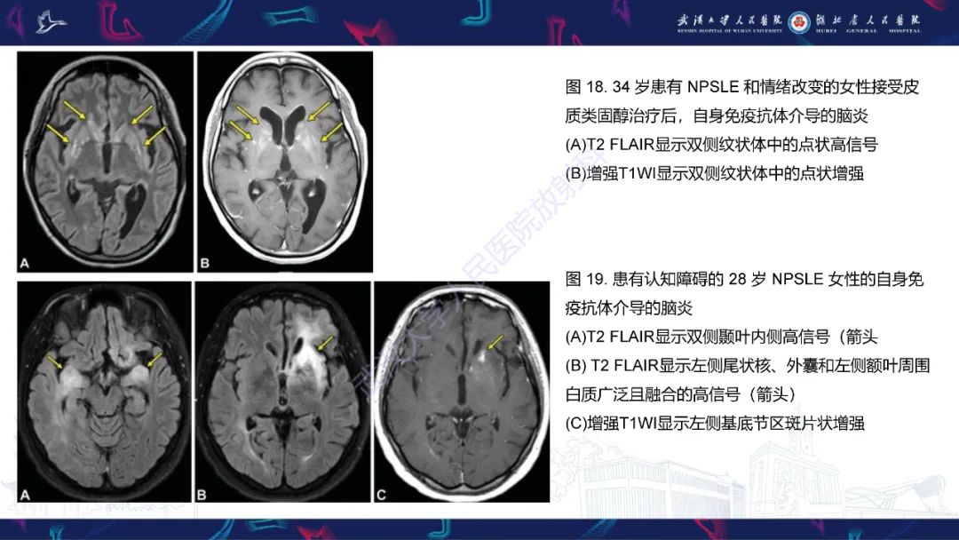 影像PPT - 【PPT】中枢神经系统性红斑狼疮影像诊断-25
