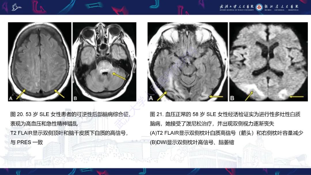 影像PPT - 【PPT】中枢神经系统性红斑狼疮影像诊断-27