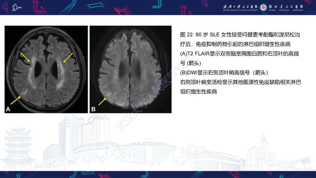 影像PPT - 【PPT】中枢神经系统性红斑狼疮影像诊断-28