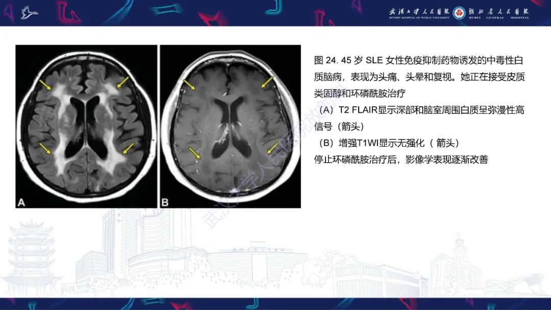 影像PPT - 【PPT】中枢神经系统性红斑狼疮影像诊断-30