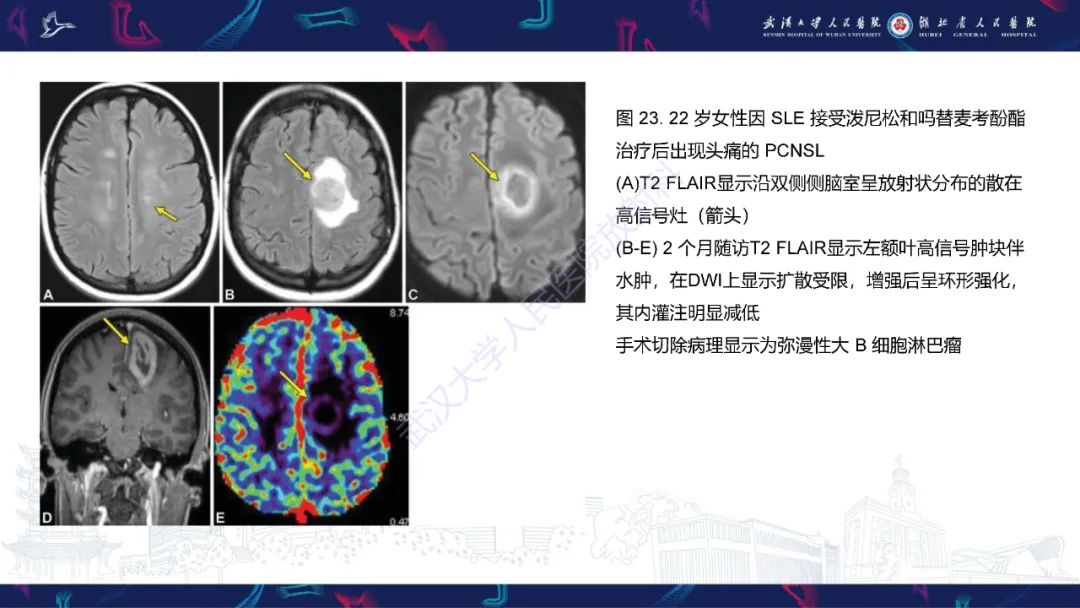 影像PPT - 【PPT】中枢神经系统性红斑狼疮影像诊断-29