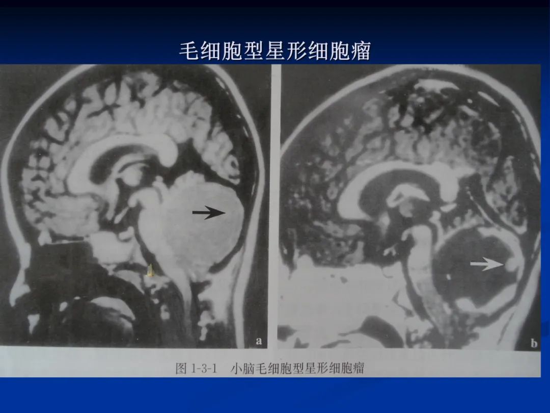 影像PPT - 【PPT】脑肿瘤影像学诊断-17