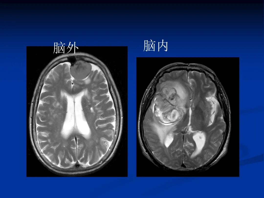 影像PPT - 【PPT】脑肿瘤影像学诊断-7