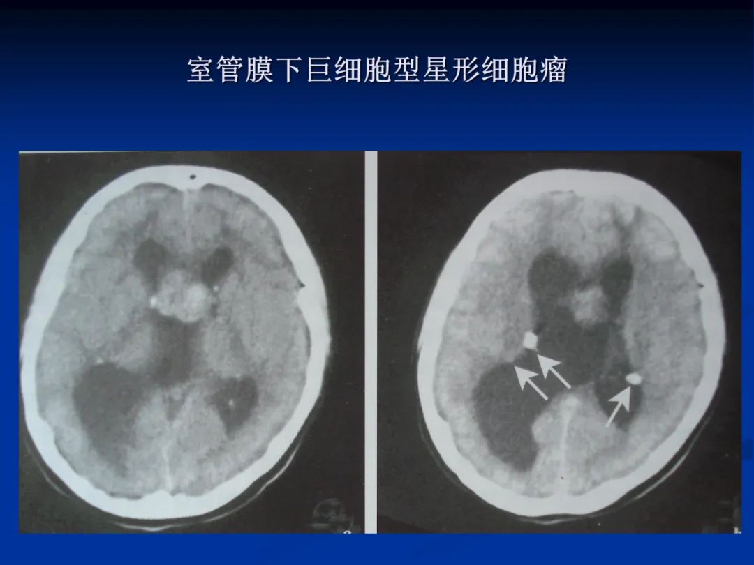 影像PPT - 【PPT】脑肿瘤影像学诊断-18