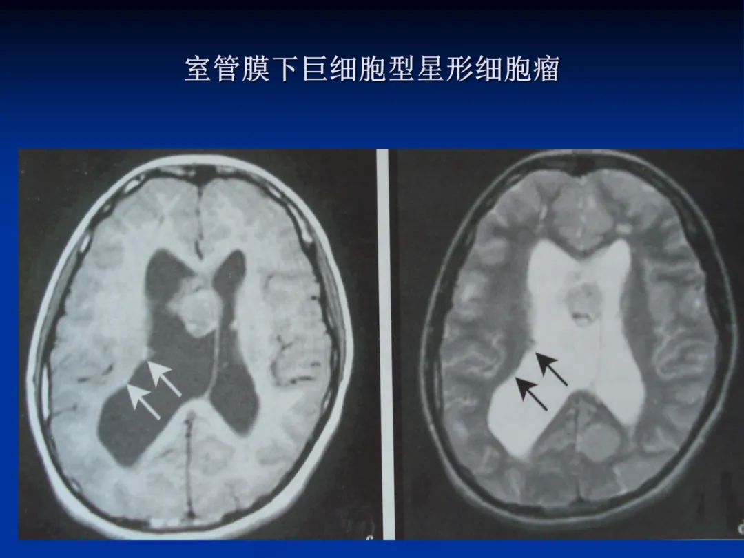 影像PPT - 【PPT】脑肿瘤影像学诊断-19