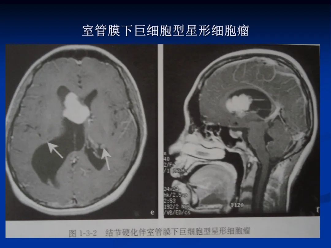 影像PPT - 【PPT】脑肿瘤影像学诊断-20