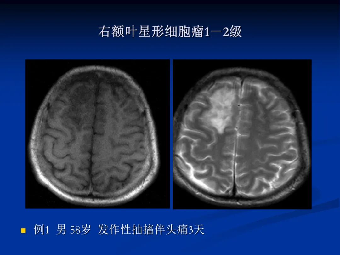 影像PPT - 【PPT】脑肿瘤影像学诊断-21