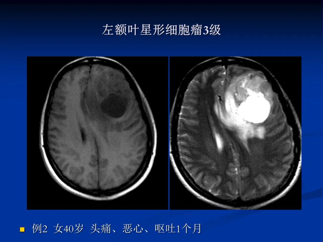 影像PPT - 【PPT】脑肿瘤影像学诊断-23