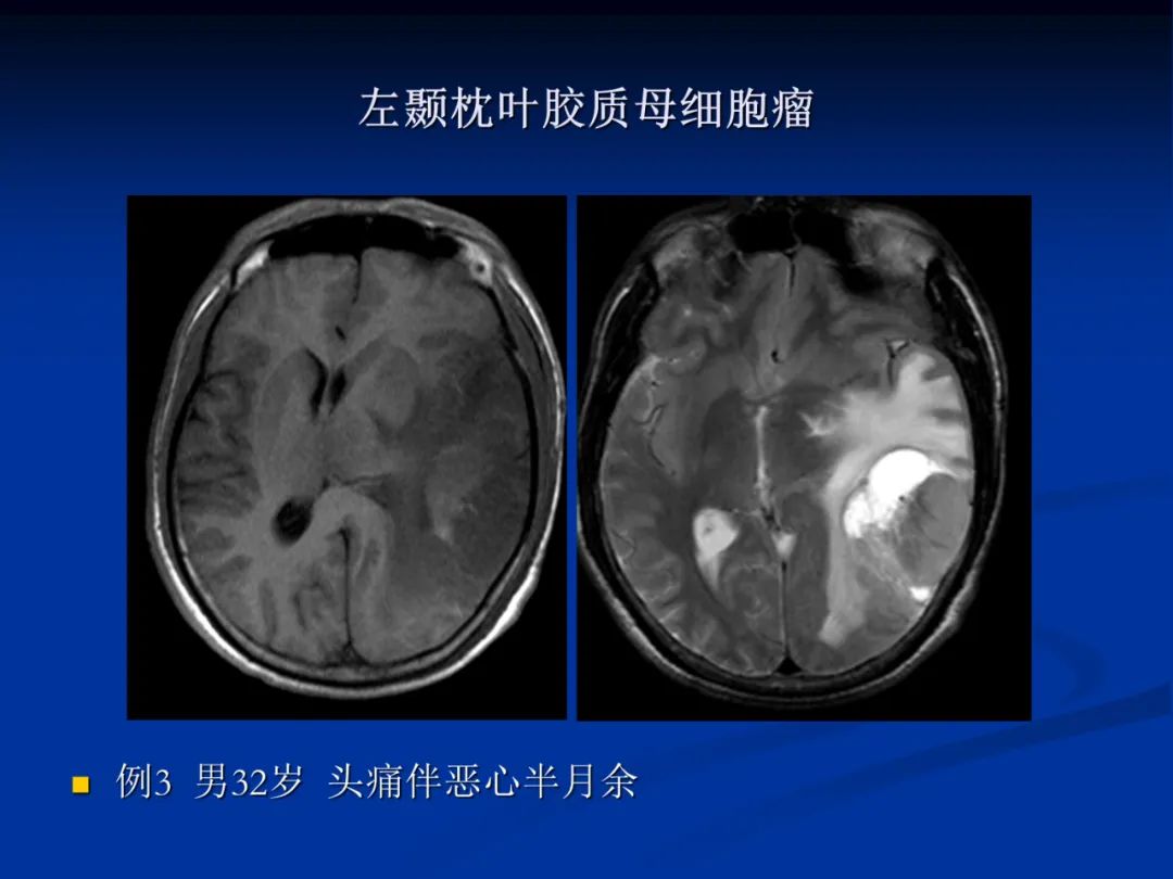影像PPT - 【PPT】脑肿瘤影像学诊断-25