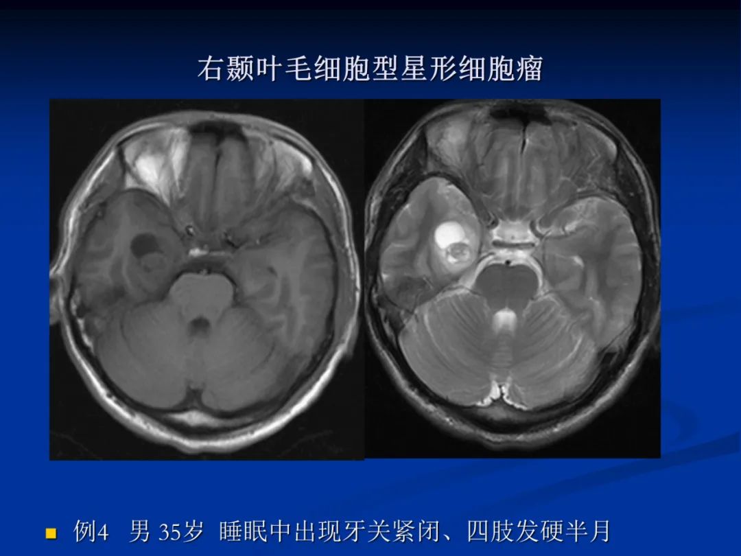 影像PPT - 【PPT】脑肿瘤影像学诊断-27