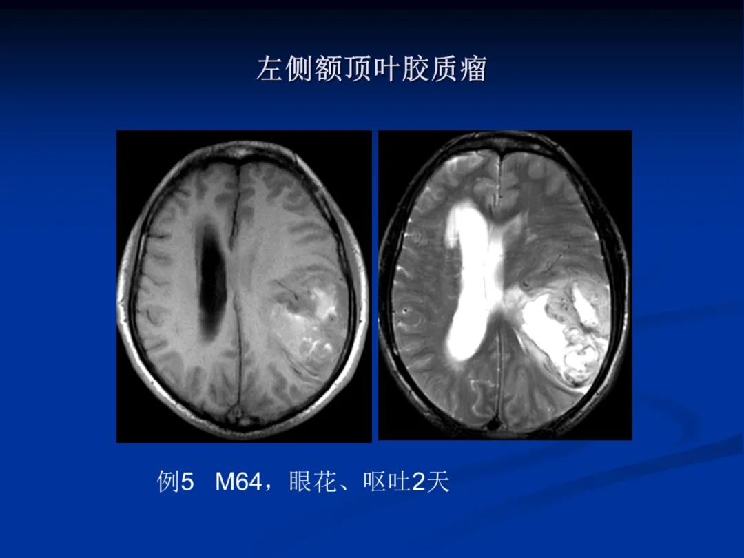 影像PPT - 【PPT】脑肿瘤影像学诊断-29