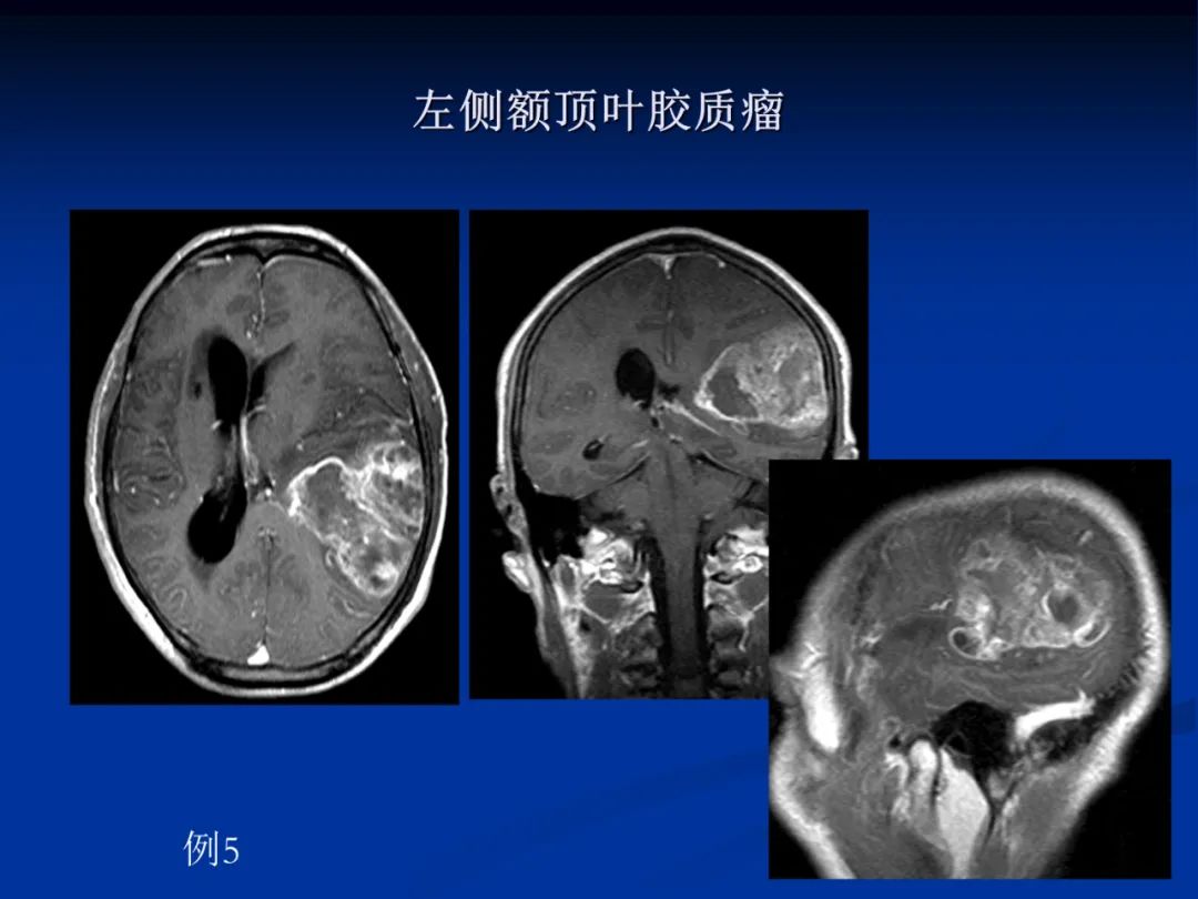 影像PPT - 【PPT】脑肿瘤影像学诊断-30