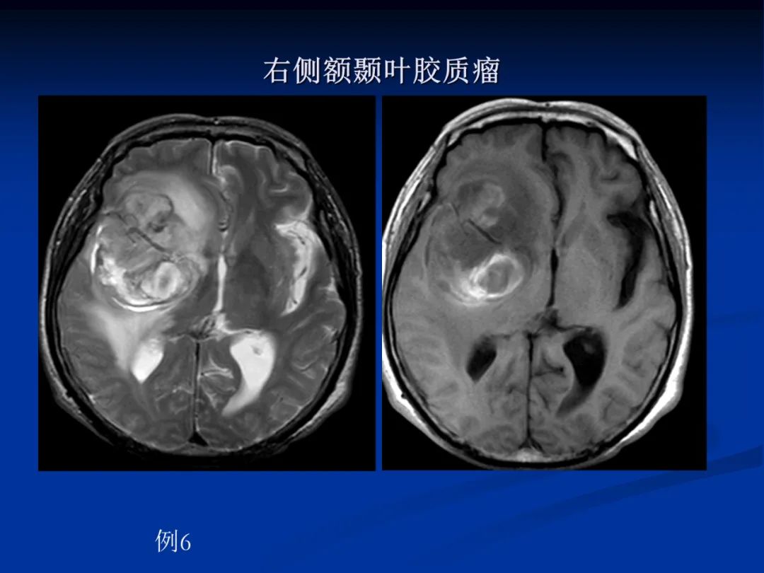 影像PPT - 【PPT】脑肿瘤影像学诊断-31