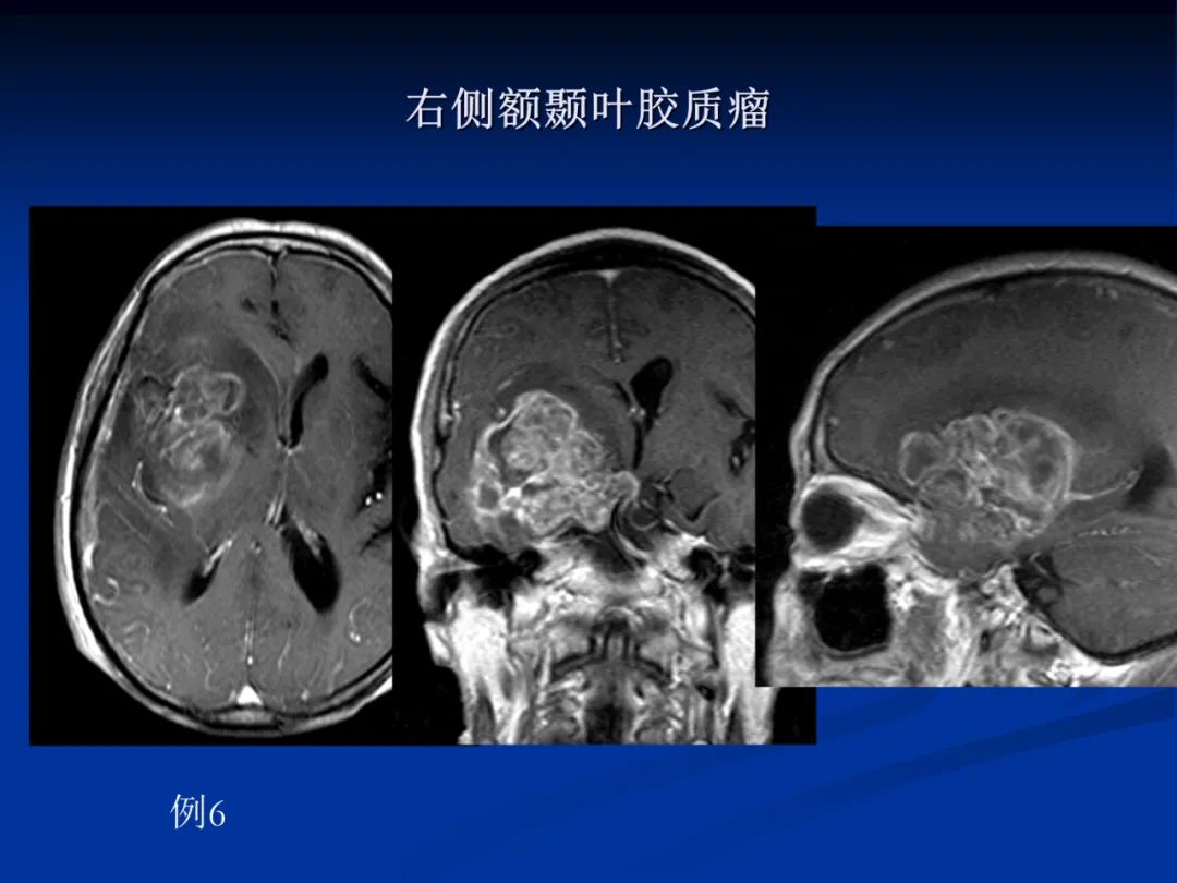 影像PPT - 【PPT】脑肿瘤影像学诊断-32